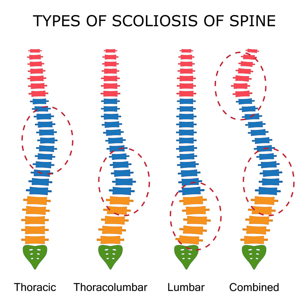 Chiropractic Therapy Treatment for Scoliosis